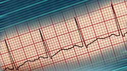EKG-Kurve