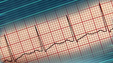 EKG-Kurve