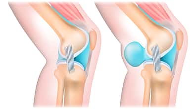 Gesundes Knie und Knie mit Bakerzyste (rechts)