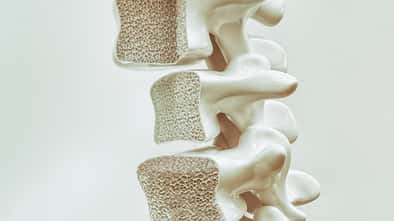 Osteoporosis on the spine - 3d rendering