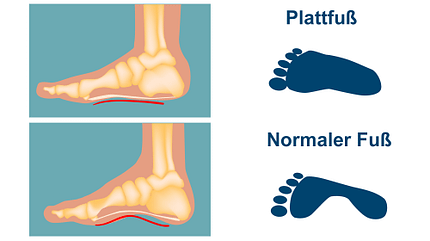 Plattfuß und normaler Fuß Plattfuß und normaler Fuß