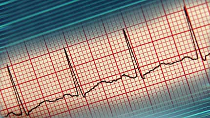 EKG-Kurve