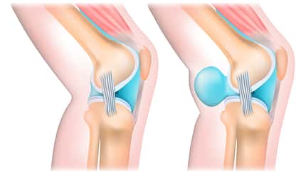 Gesundes Knie und Knie mit Bakerzyste (rechts)