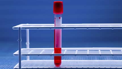 Eigenbluttherapie (PRP)