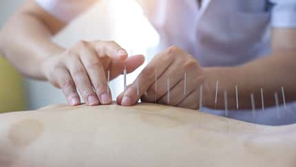 Nadeltherapie