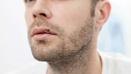 Darf man mit Lippenherpes laufen?