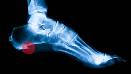 Injured runner
