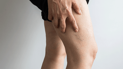 Thrombose bei Ausdauersportlern