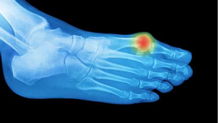 Hallux Valgus