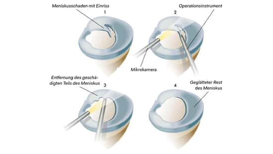 Ablauf der modernen Meniskus-Operation