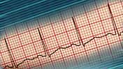 EKG-Kurve
