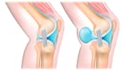 Gesundes Knie und Knie mit Bakerzyste (rechts)
