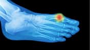 Hallux Valgus